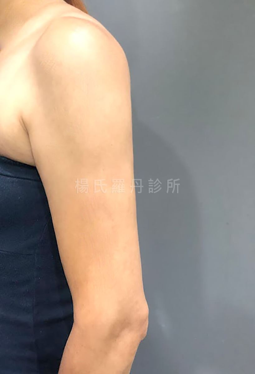 雷射減脂 瘦手臂 手臂抽脂