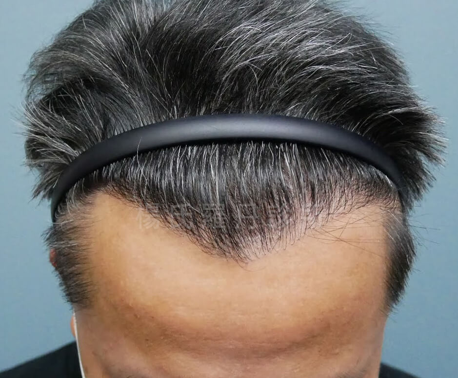 植髮 落髮 植髮手術