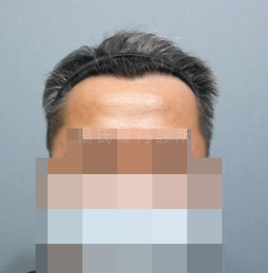 植髮手術 植髮成果 植髮
