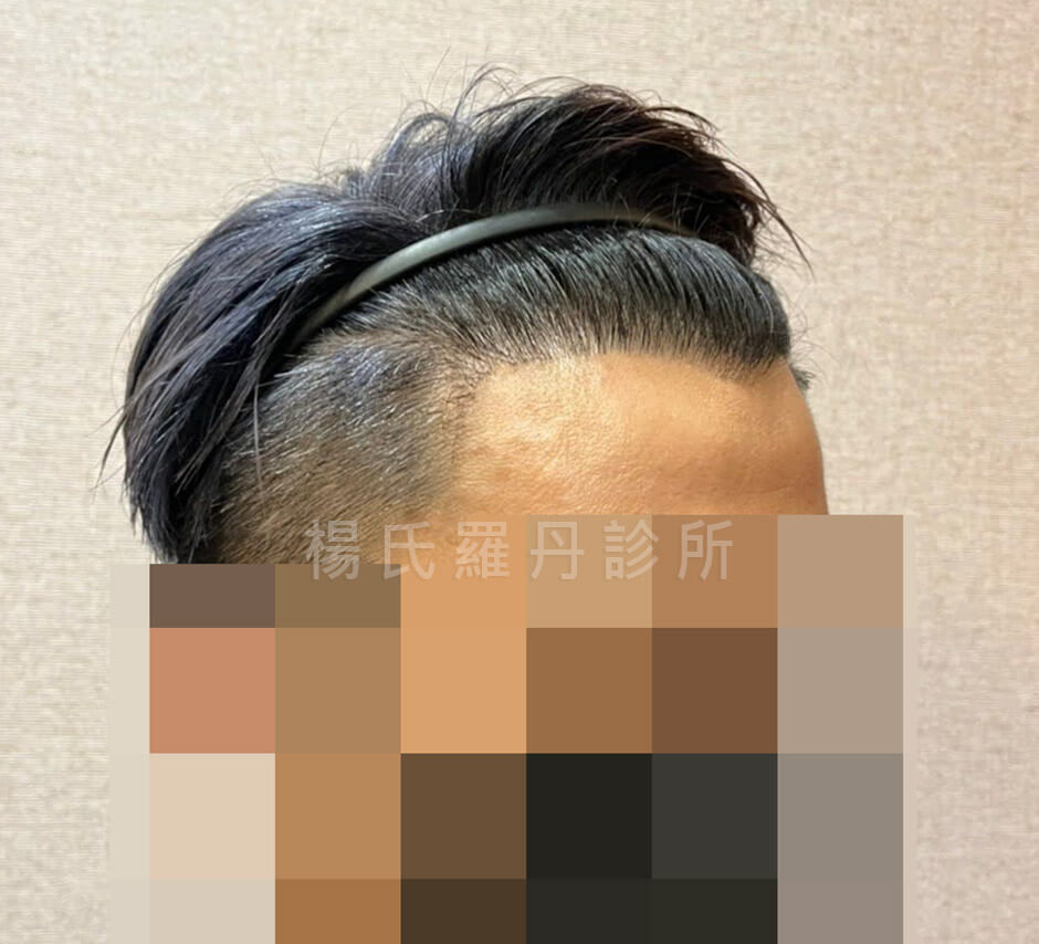 落髮 植髮 植髮成果