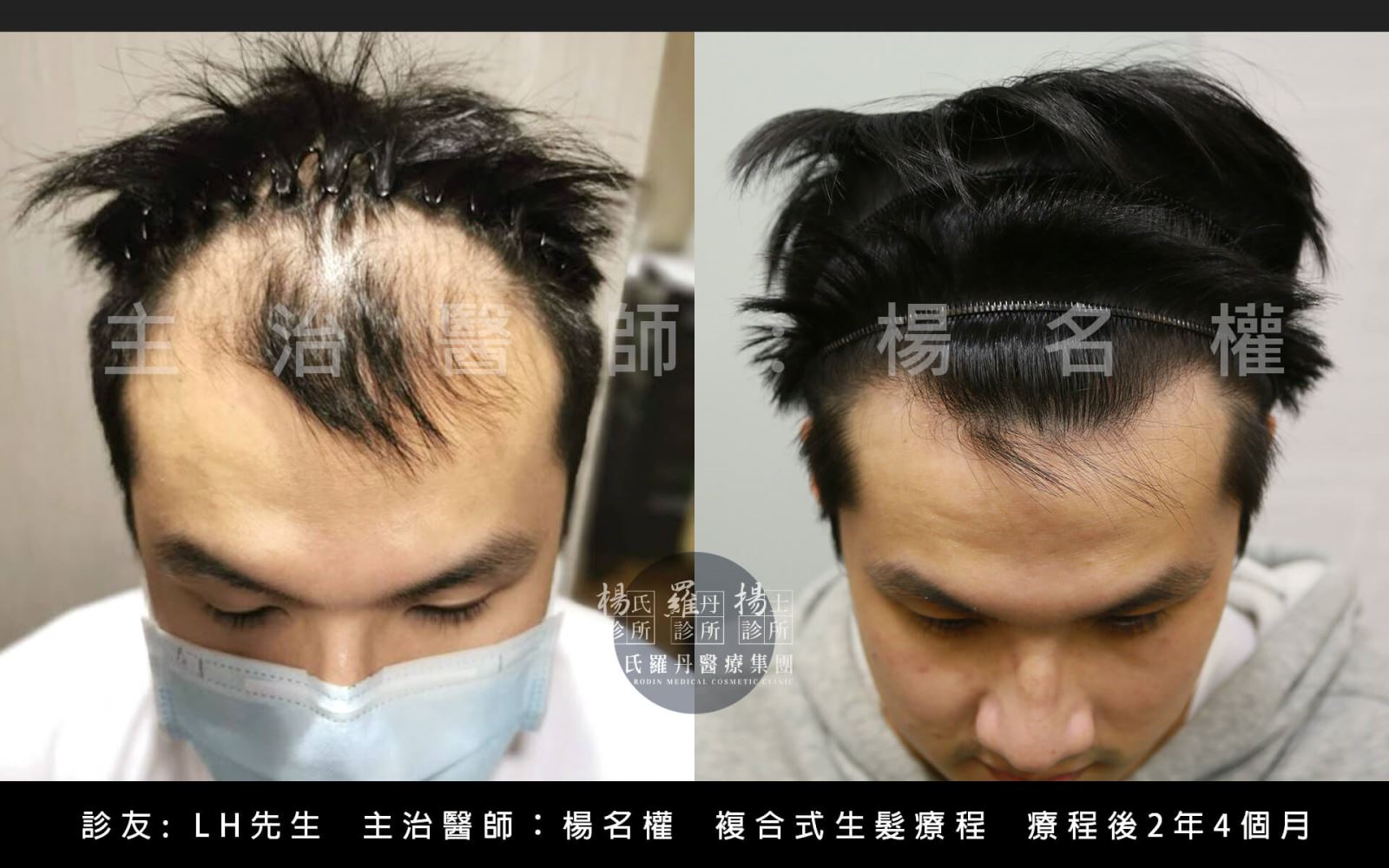 生髮 生髮治療 生髮613