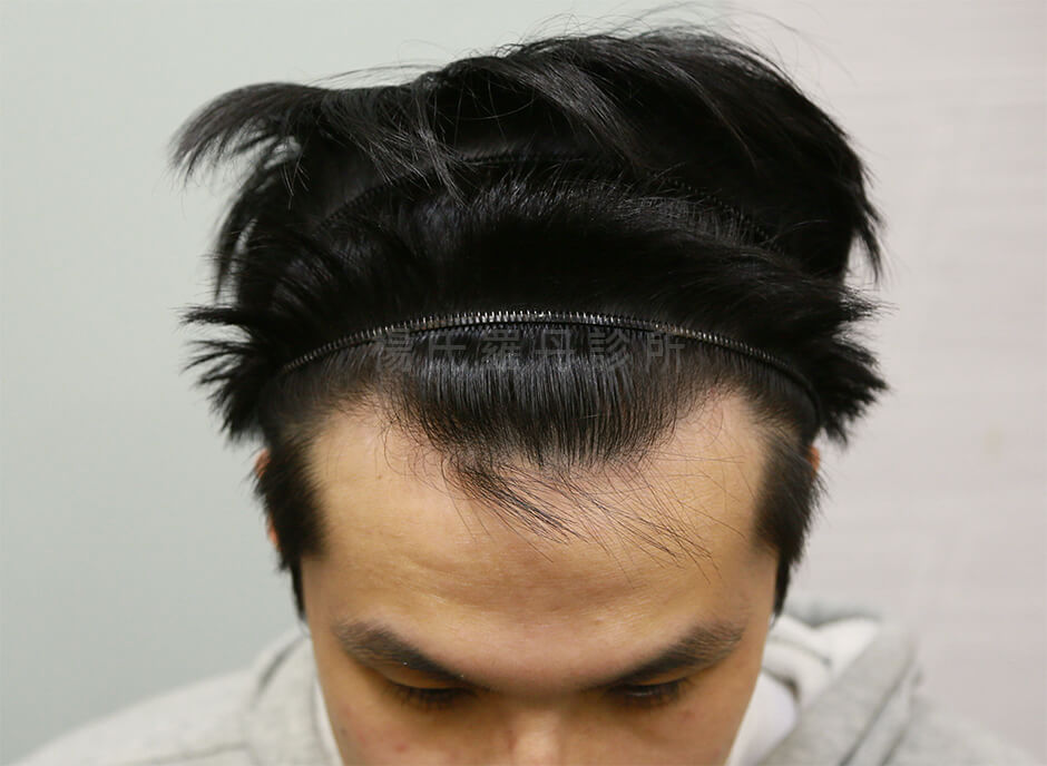 生髮治療 禿頭 生髮