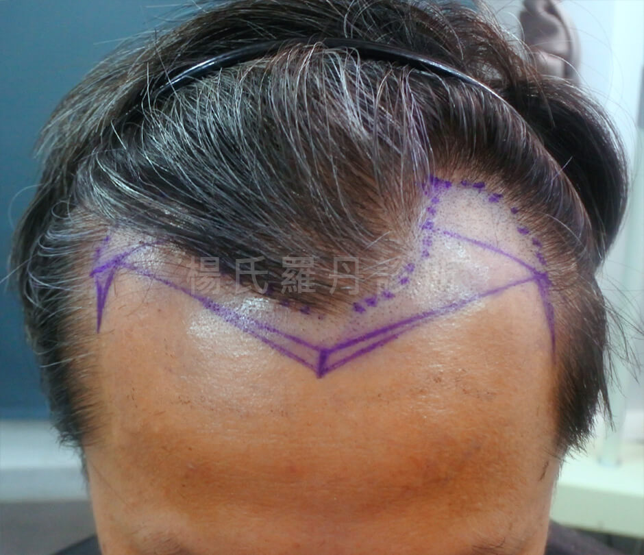 植髮 植髮成果 植髮手術