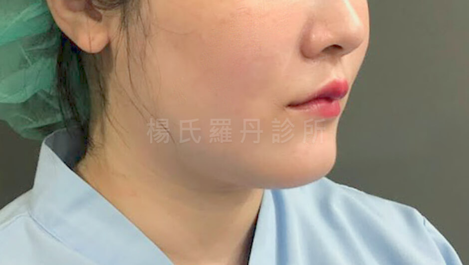 雷射減脂 雙下巴 下巴