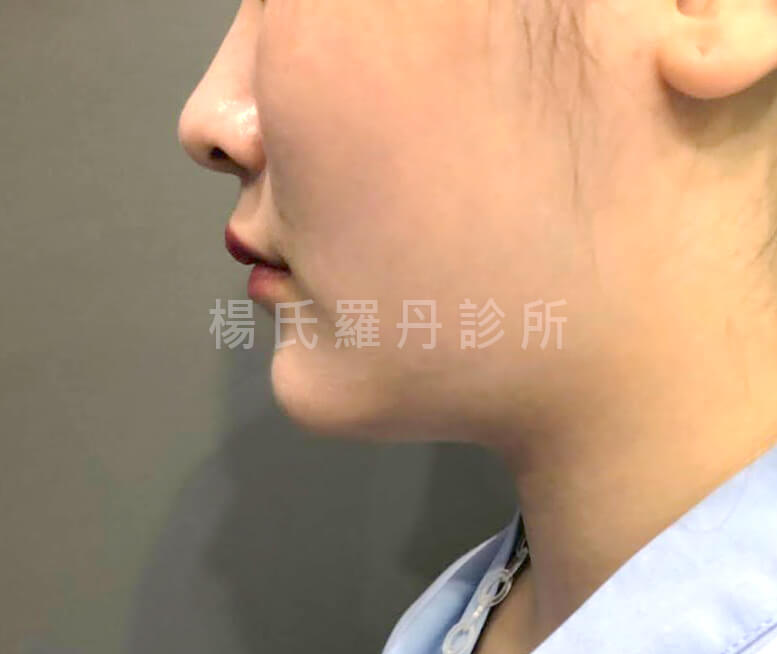 下巴抽脂 下巴 輪廓線