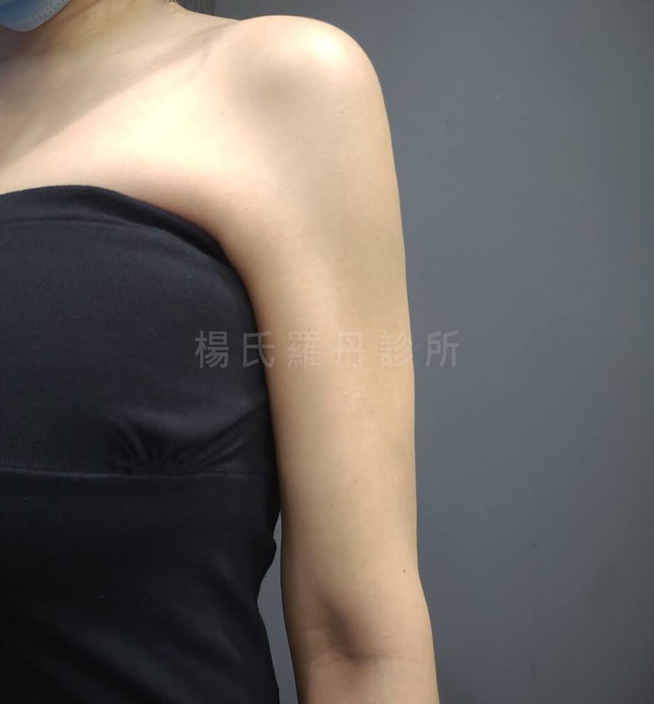 雷射減脂 抽脂 贅肉