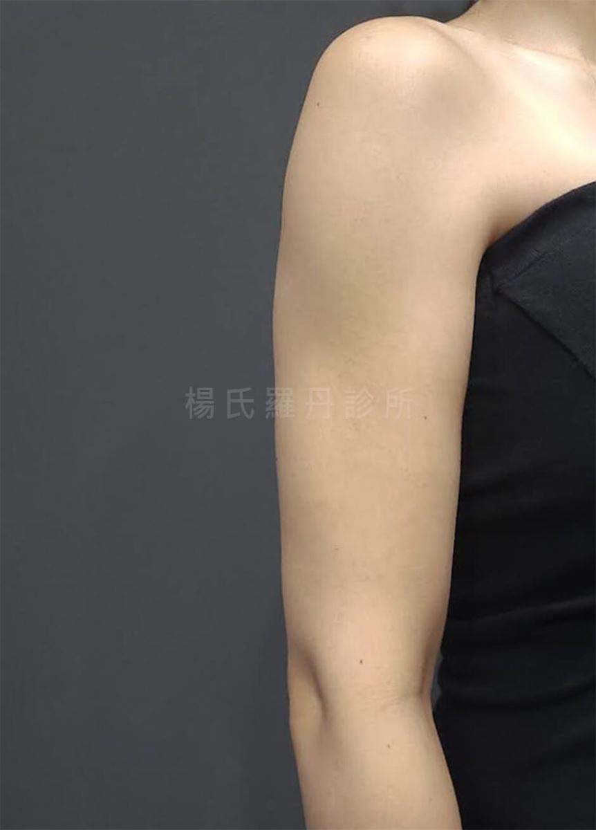 抽脂 雷射減脂 手臂