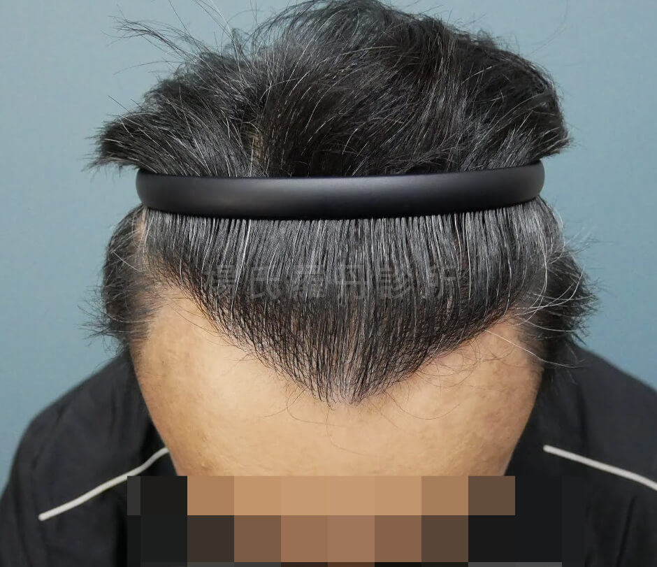 植髮手術 植髮 微創植髮