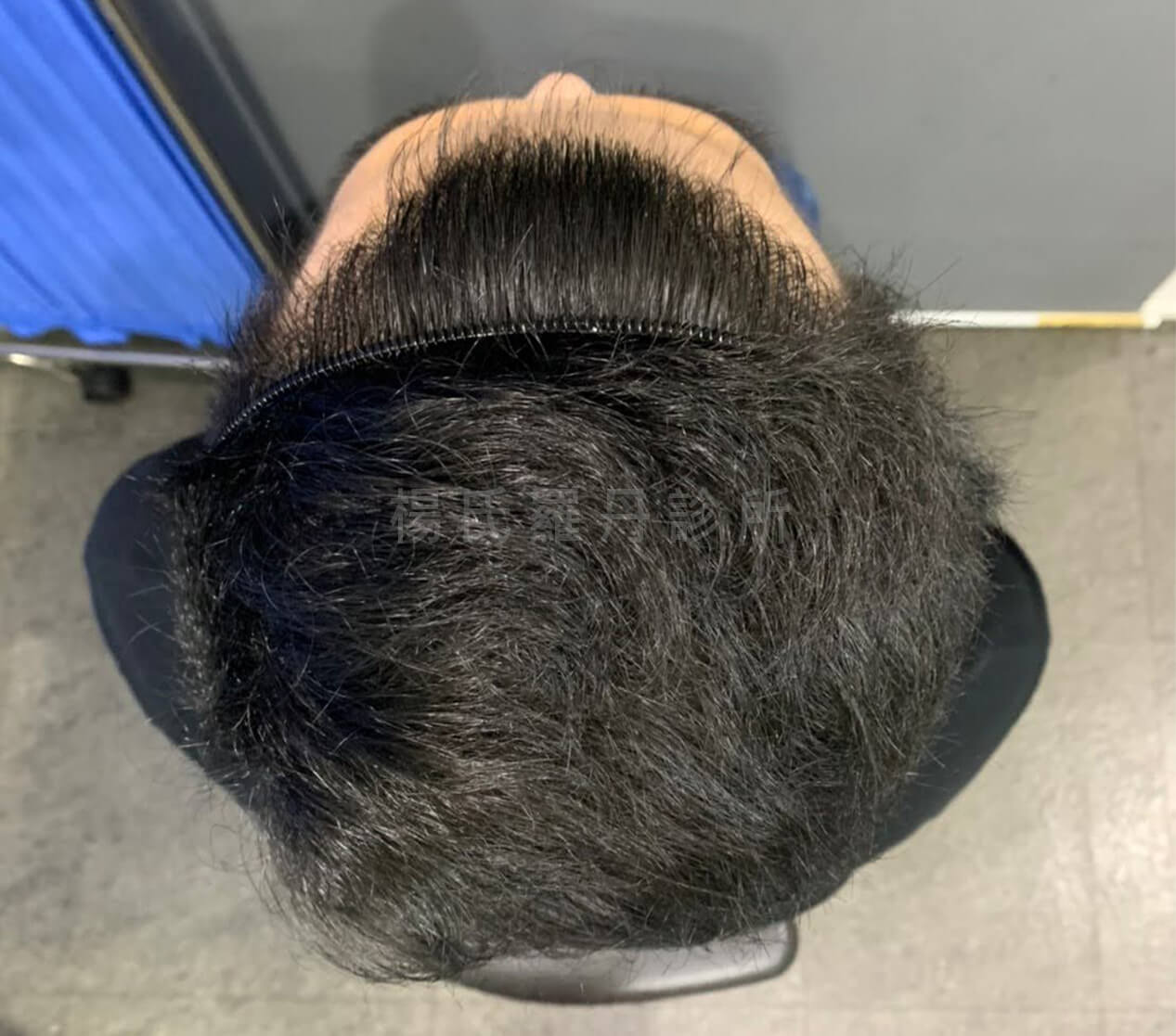 植髮 植髮手術 掉髮