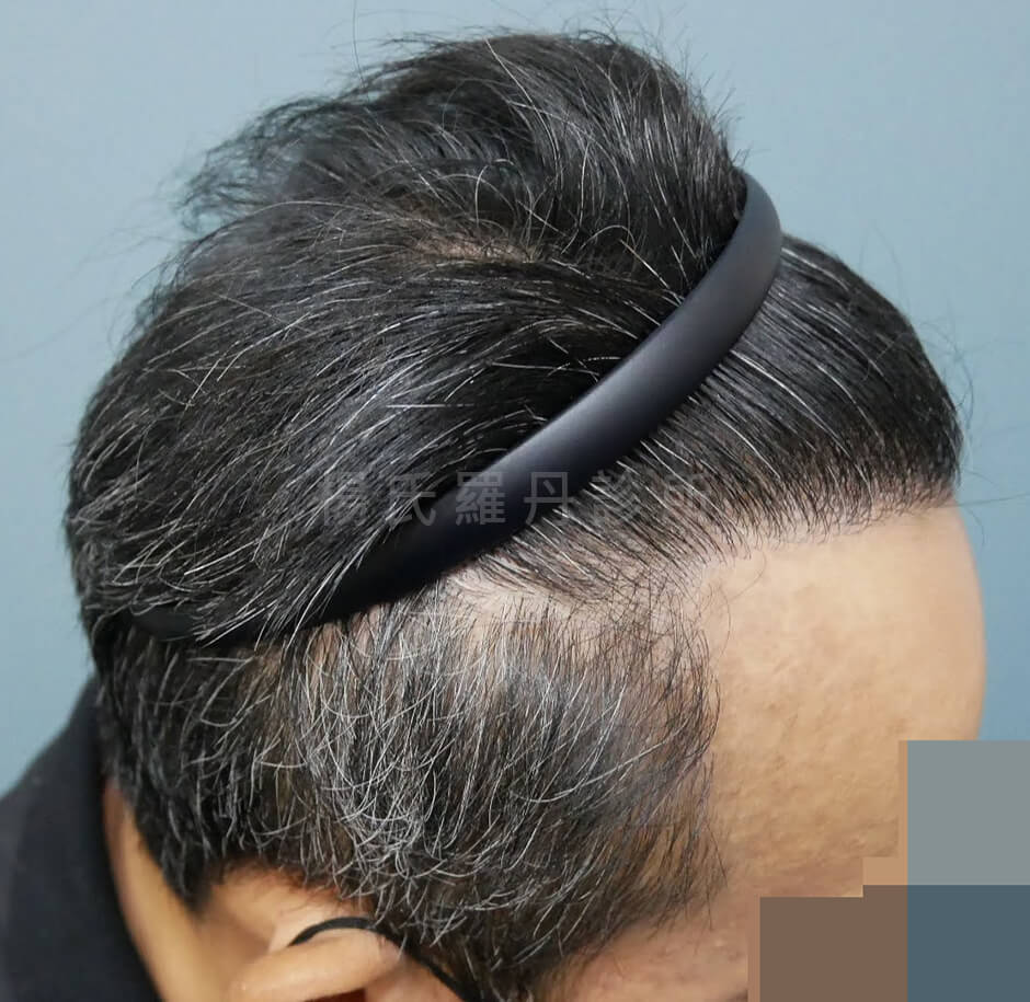 植髮 植髮手術 微創植髮