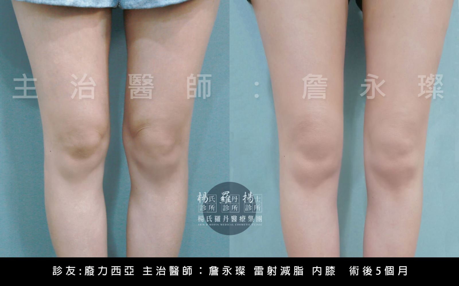 抽脂 内膝 雷射減脂