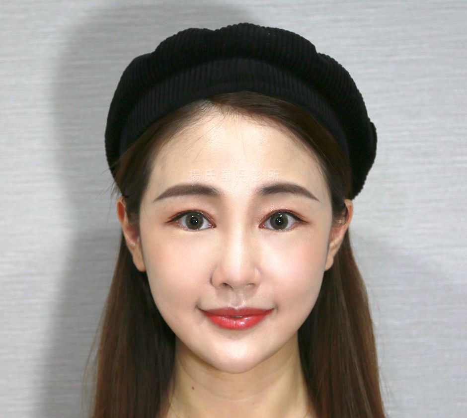 除眼袋 眼袋手術 眼袋