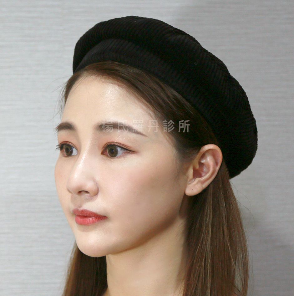 眼袋 淚溝 眼袋手術