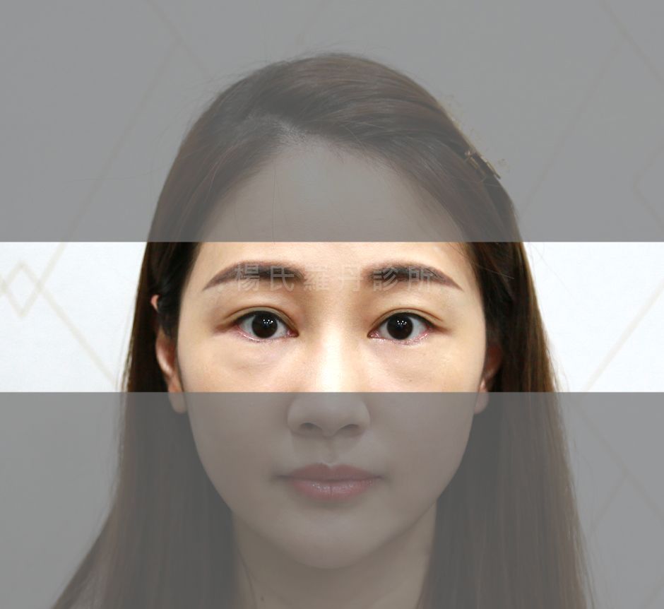 眼袋消除 除眼袋 眼袋 淚溝