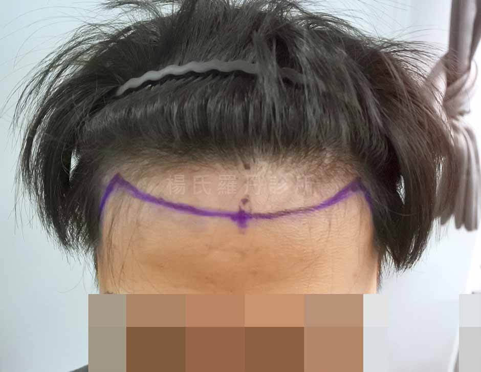 植髮 髮際線 植髮手術