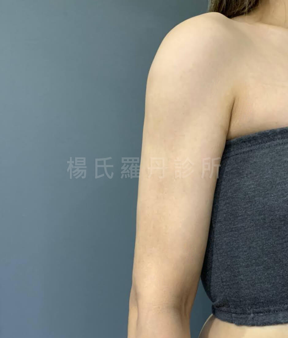 抽脂 雷射減脂 手臂抽脂