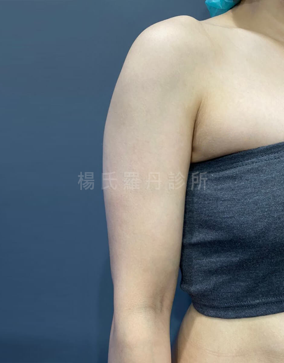 抽脂 減脂 雷射減脂