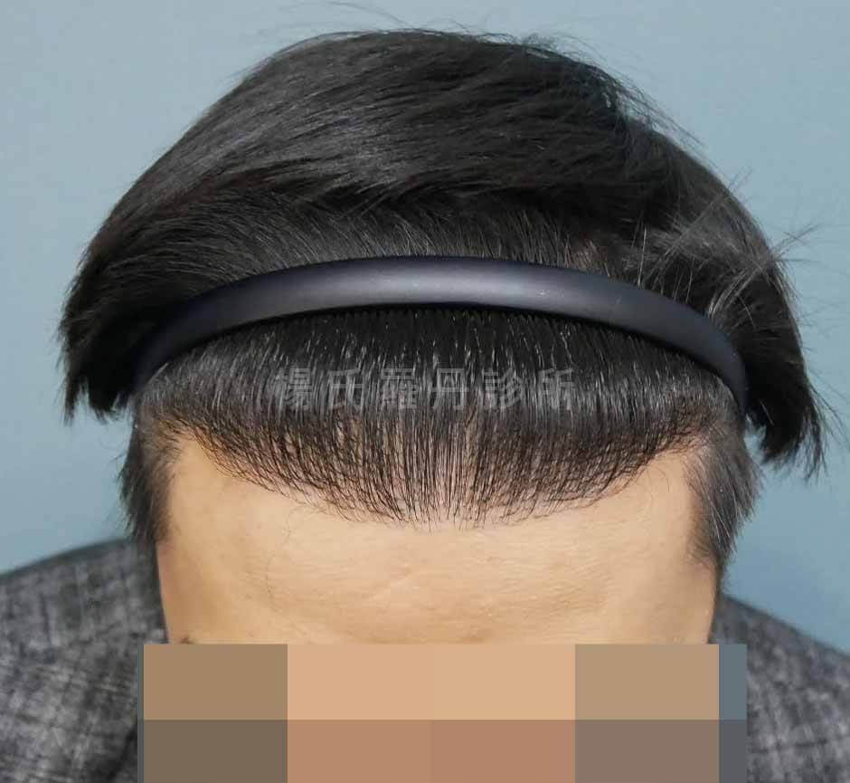 植髮 植髮手術 髮際線