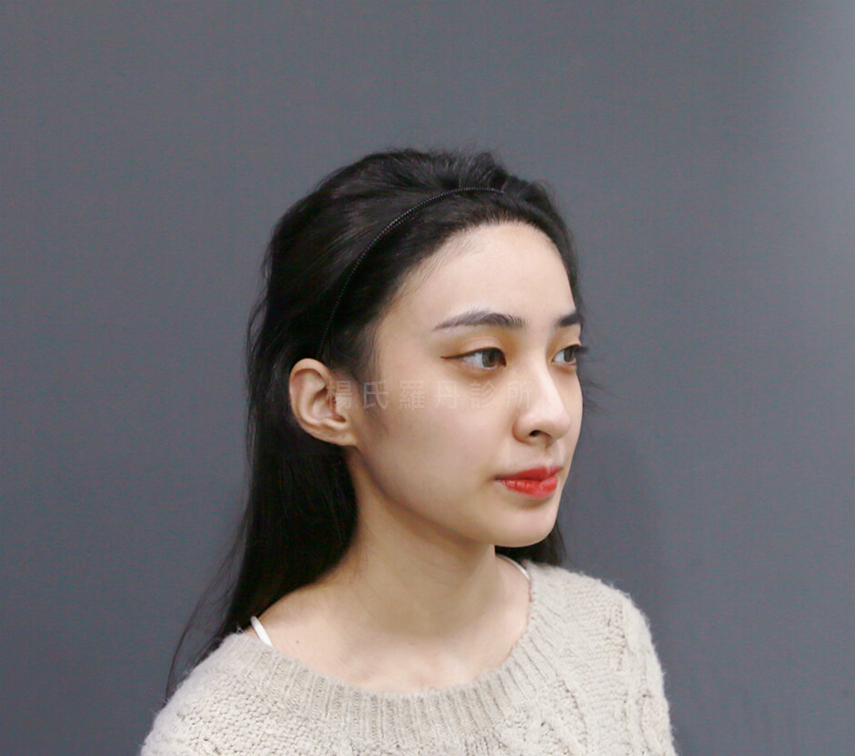 美型植髮 植髮 髮際線