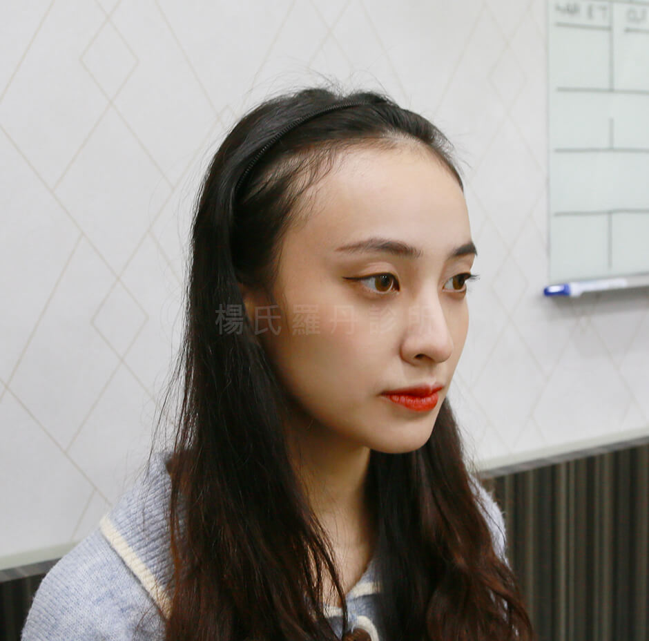 美型植髮 髮際線 植髮