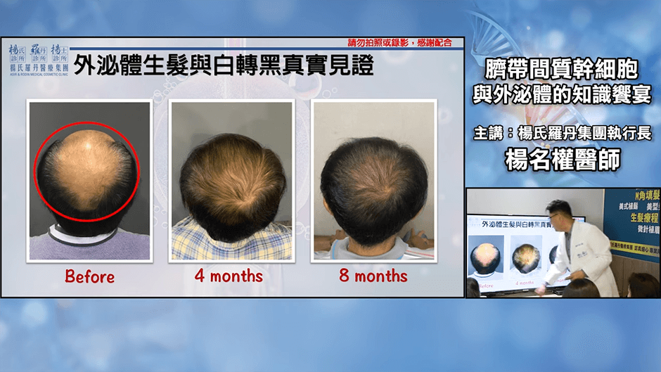 幹細胞 幹細胞治療 生髮
