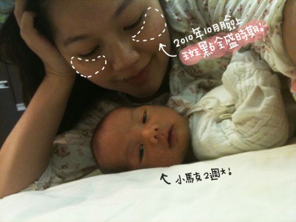 馬克媽媽 淨膚雷射 斑點全盛時期