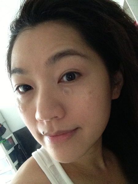 淨膚雷射 雷射除斑 馬克媽媽