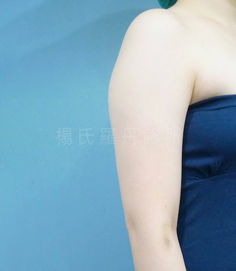 抽脂 手臂抽脂 減脂