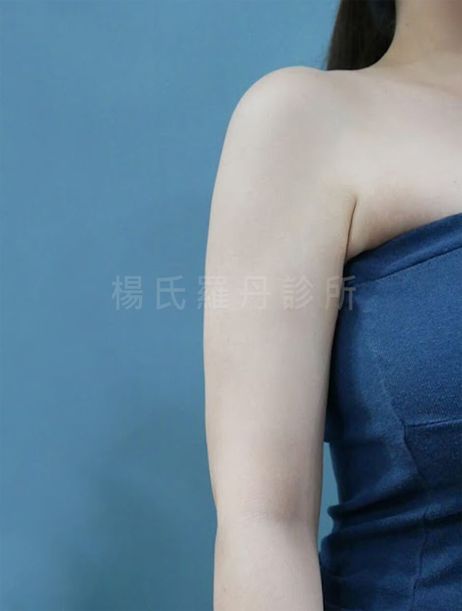 抽脂 抽脂手術 瘦手臂