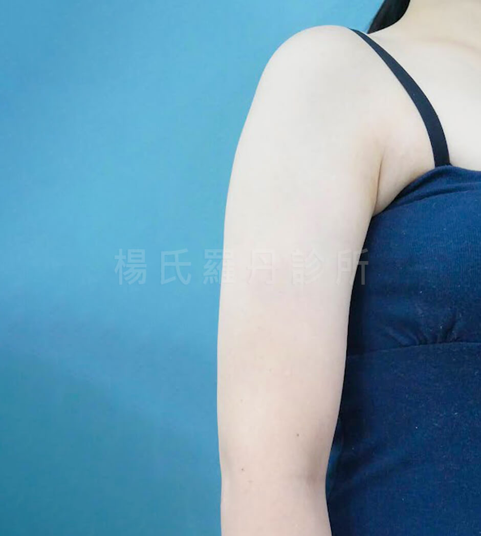 抽脂 減脂 雷射減脂 瘦手臂