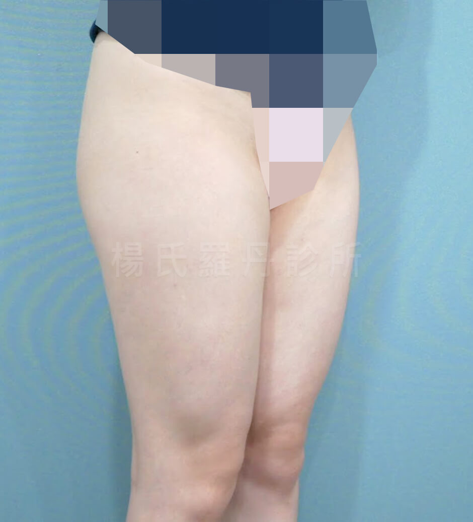雷射減脂 抽脂 大腿抽脂