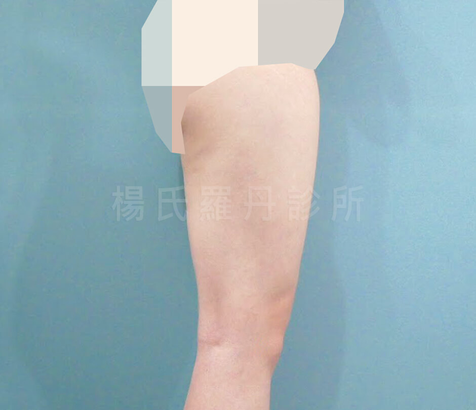 雷射減脂 減脂 瘦大腿