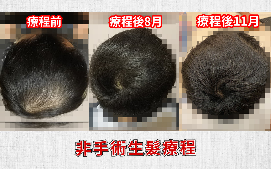 生髮 植髮 楊氏診所