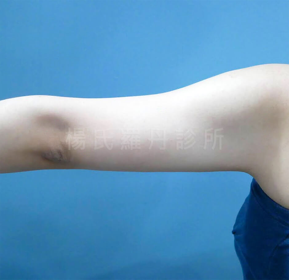 減脂手術 減脂 手臂 瘦手臂