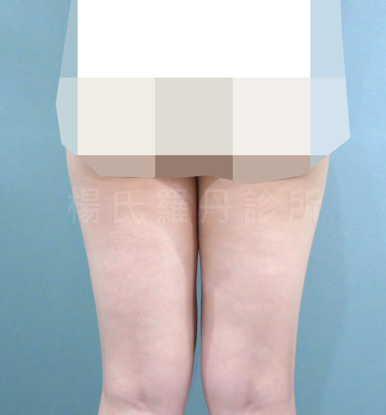 減脂 馬鞍 減脂手術