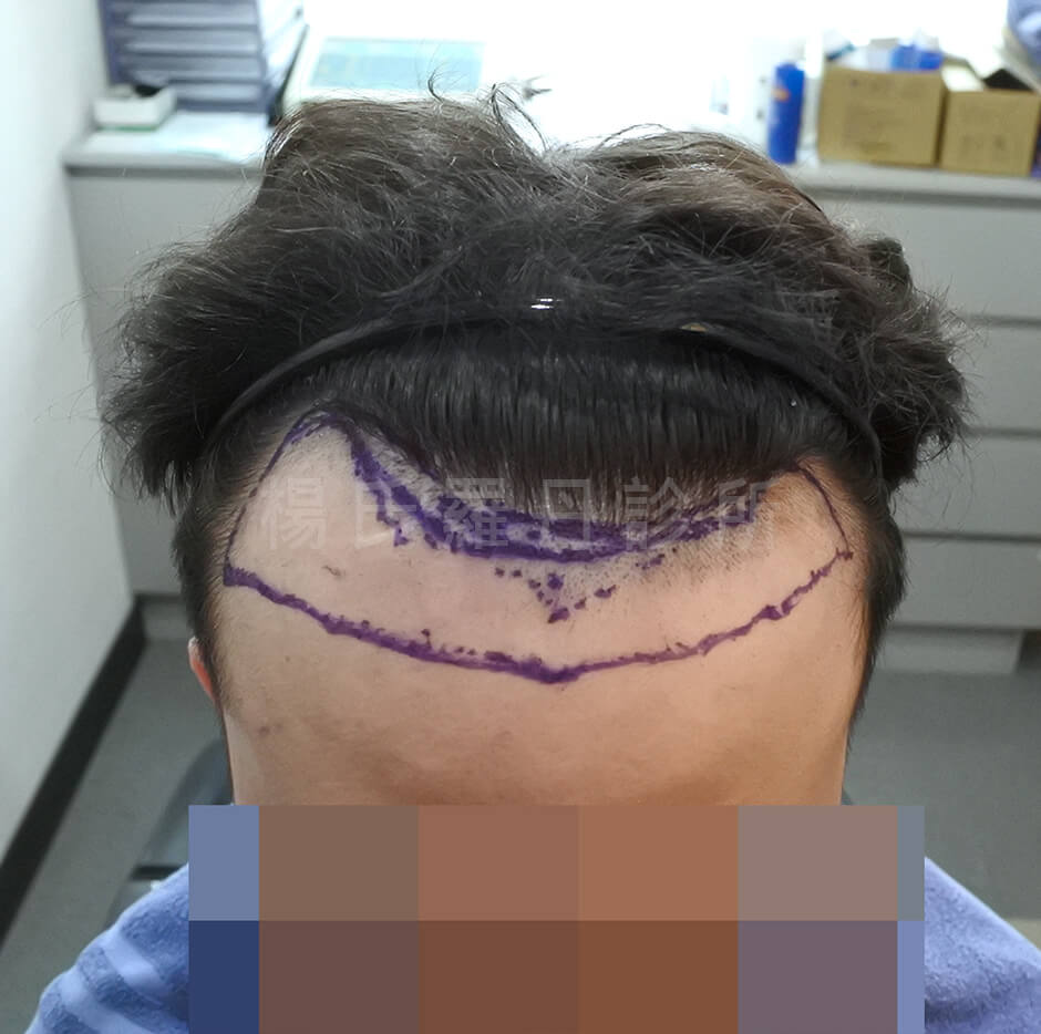 植髮 植髮手術