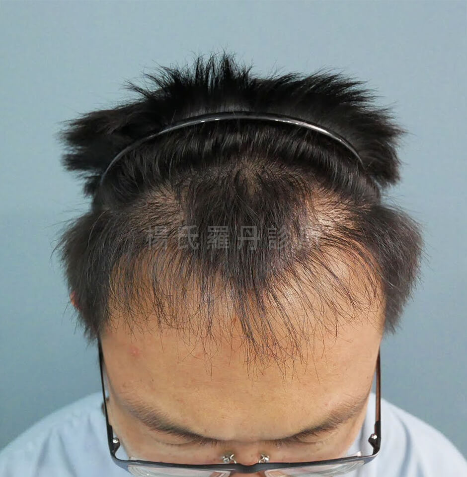 植髮 植髮手術 生髮613