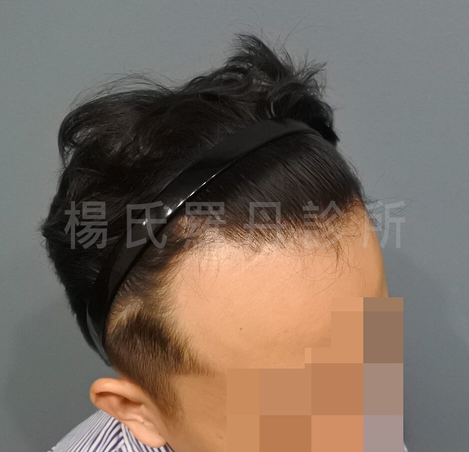 植髮 雄性禿 植髮手術