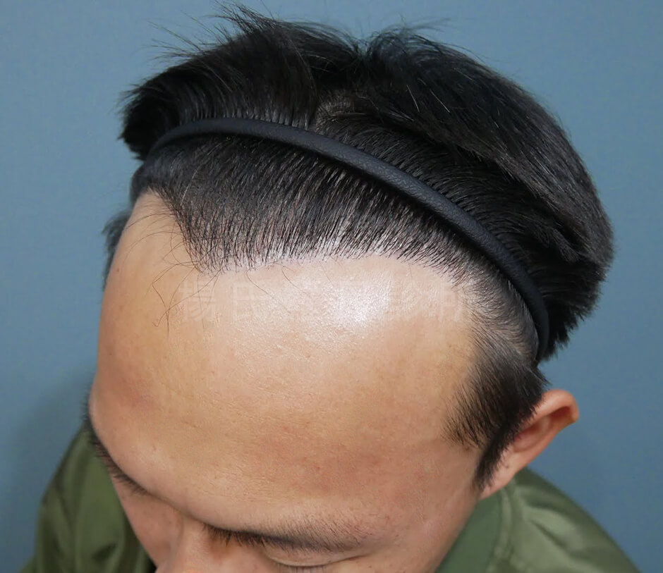 植髮 禿頭 植髮手術