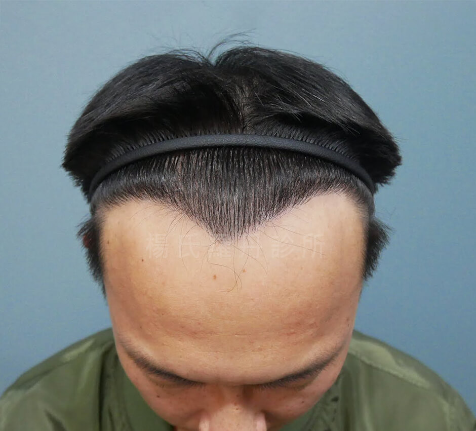 植髮 禿頭 掉髮