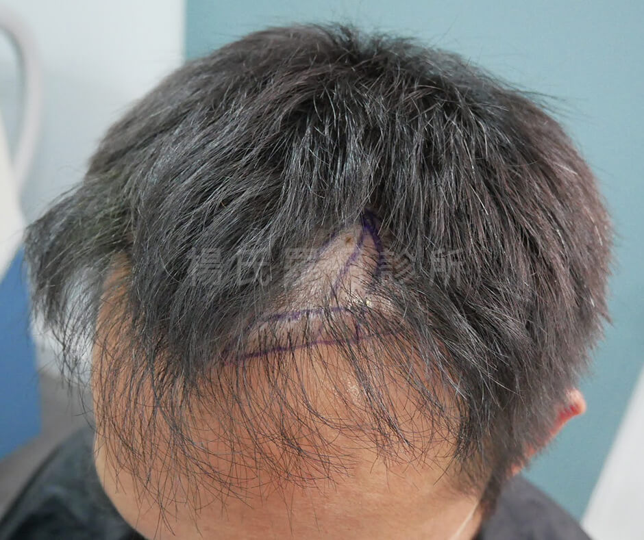 掉髮 植髮 植髮手術