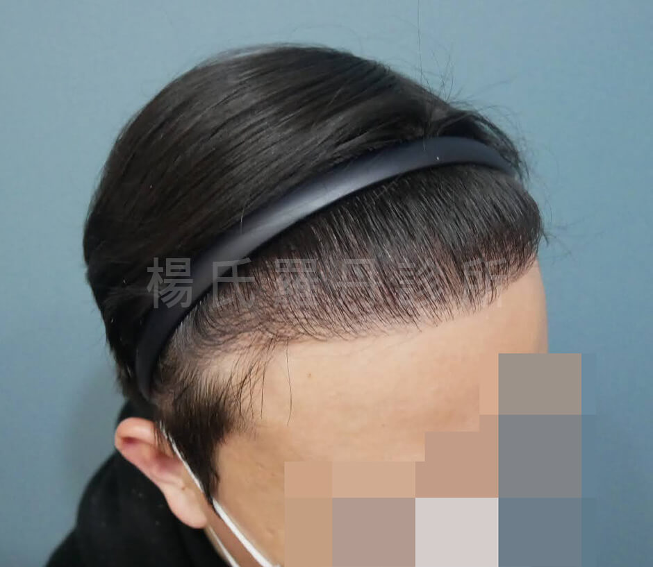 植髮手術 植髮 禿頭