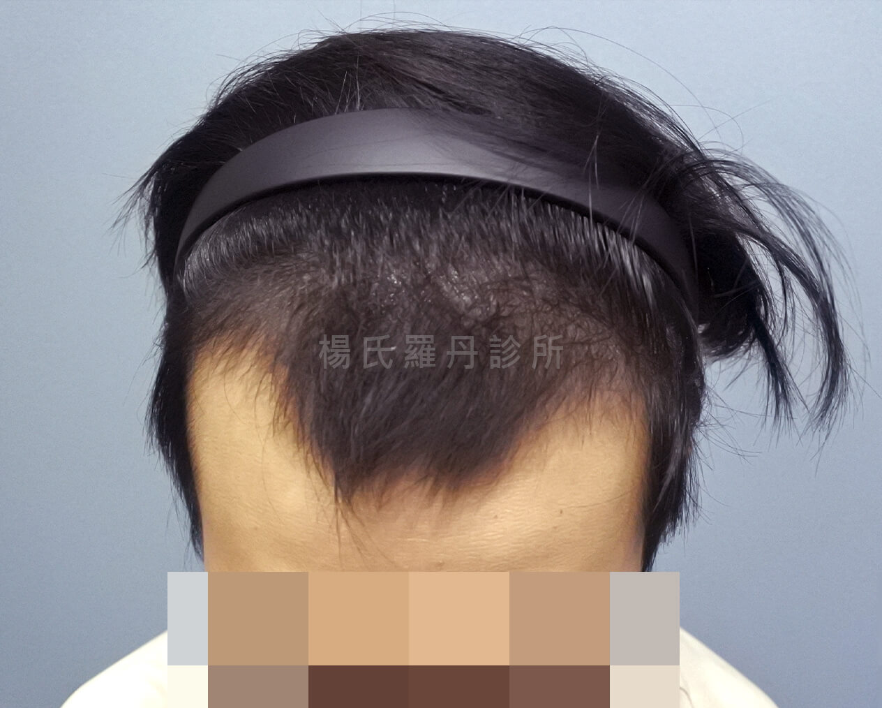 植髮 植髮手術 掉髮