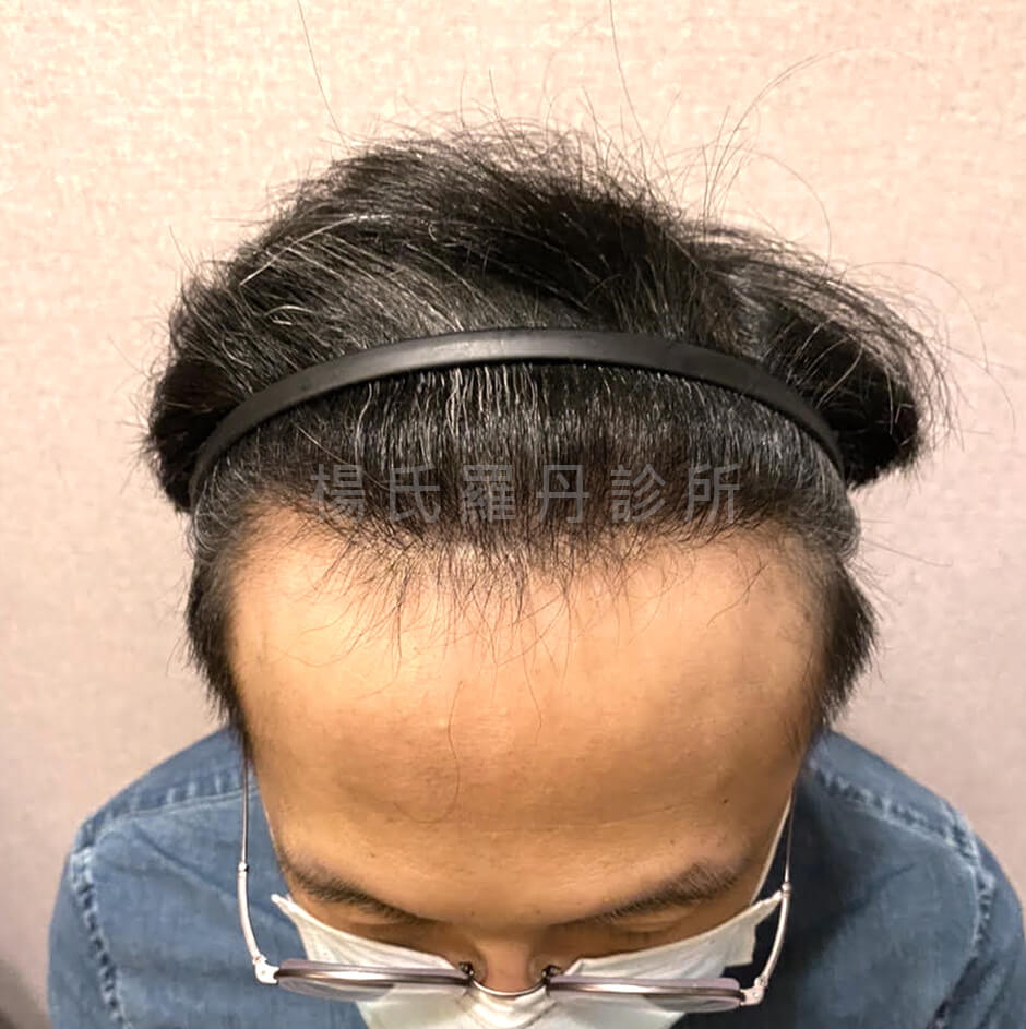 植髮 ARTAS 植髮手術