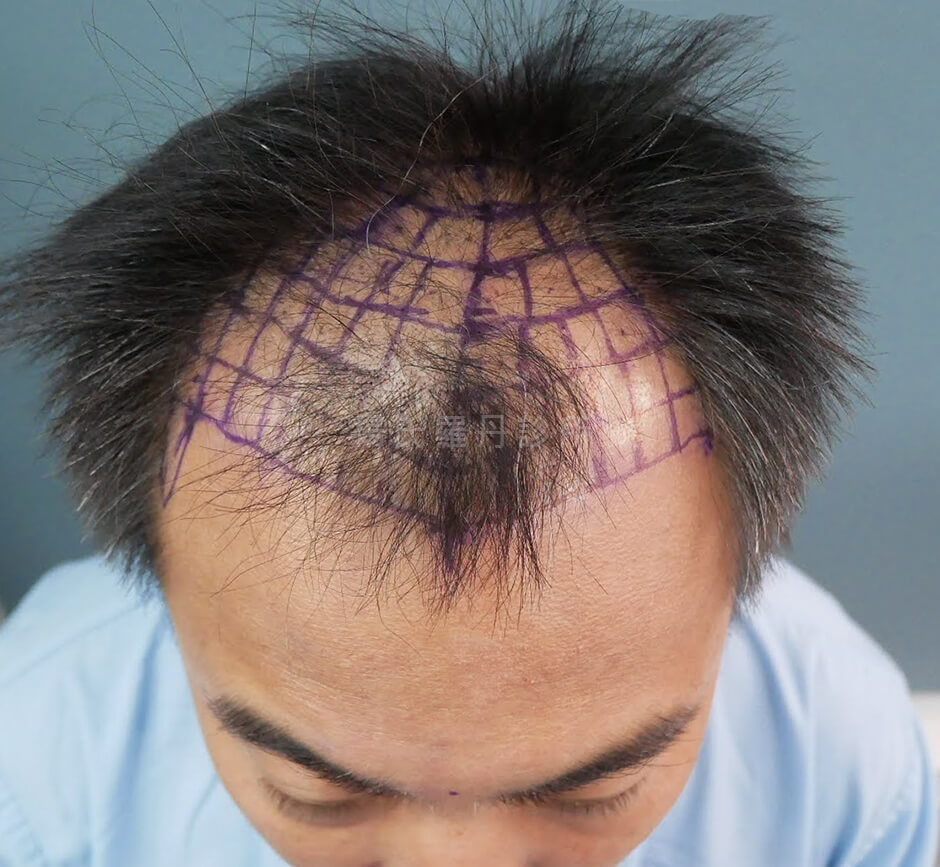 植髮 植髮手術 植髮效果