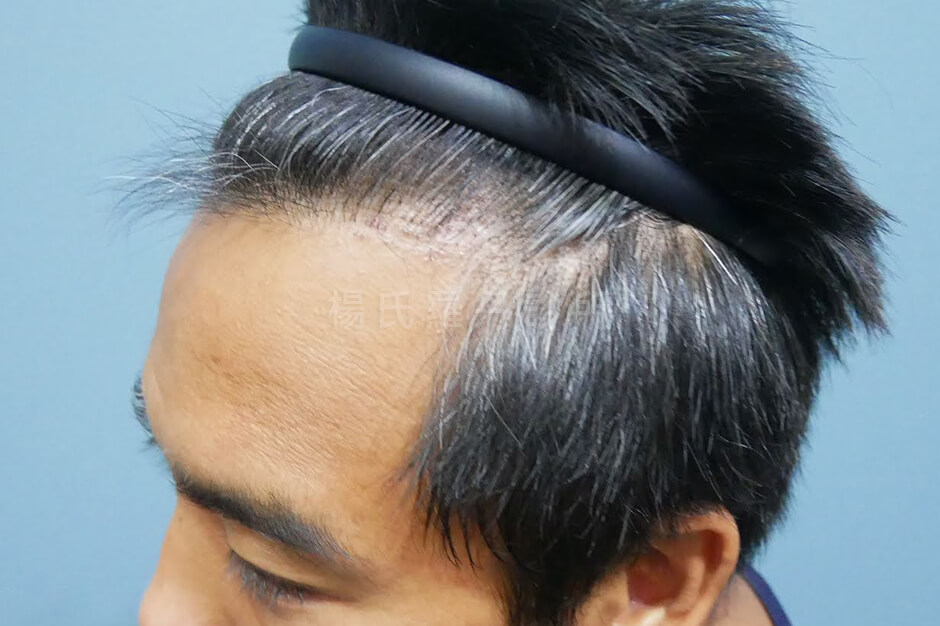 植髮 植髮手術 禿頭