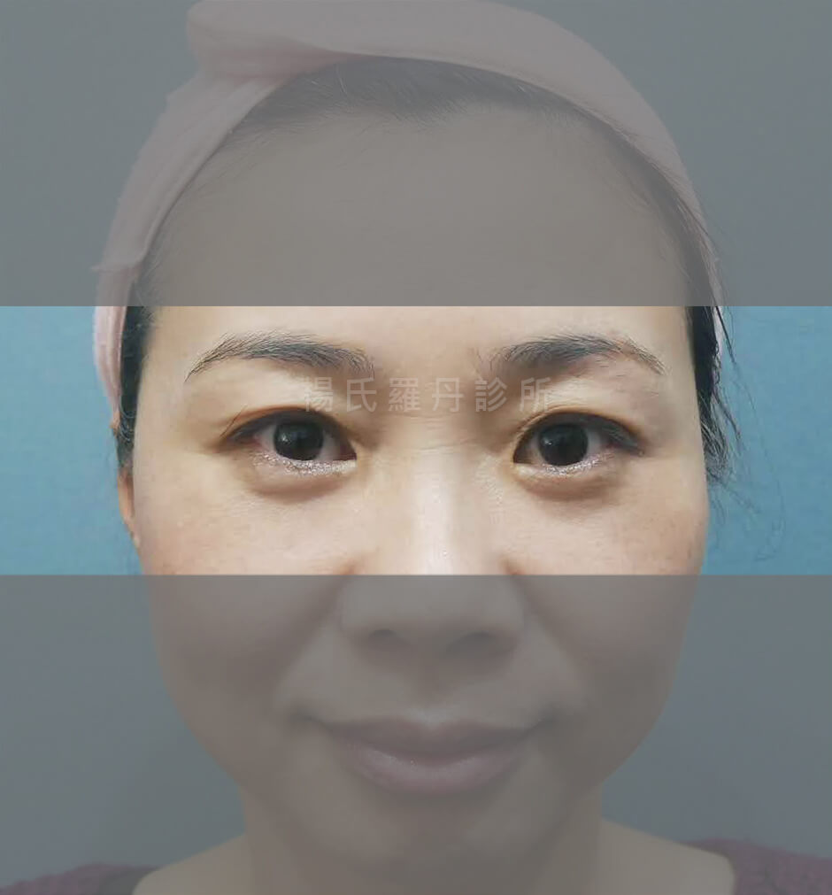 眼袋 眼袋手術 淚溝
