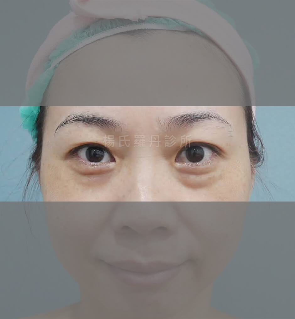 眼袋 眼袋消除 淚溝