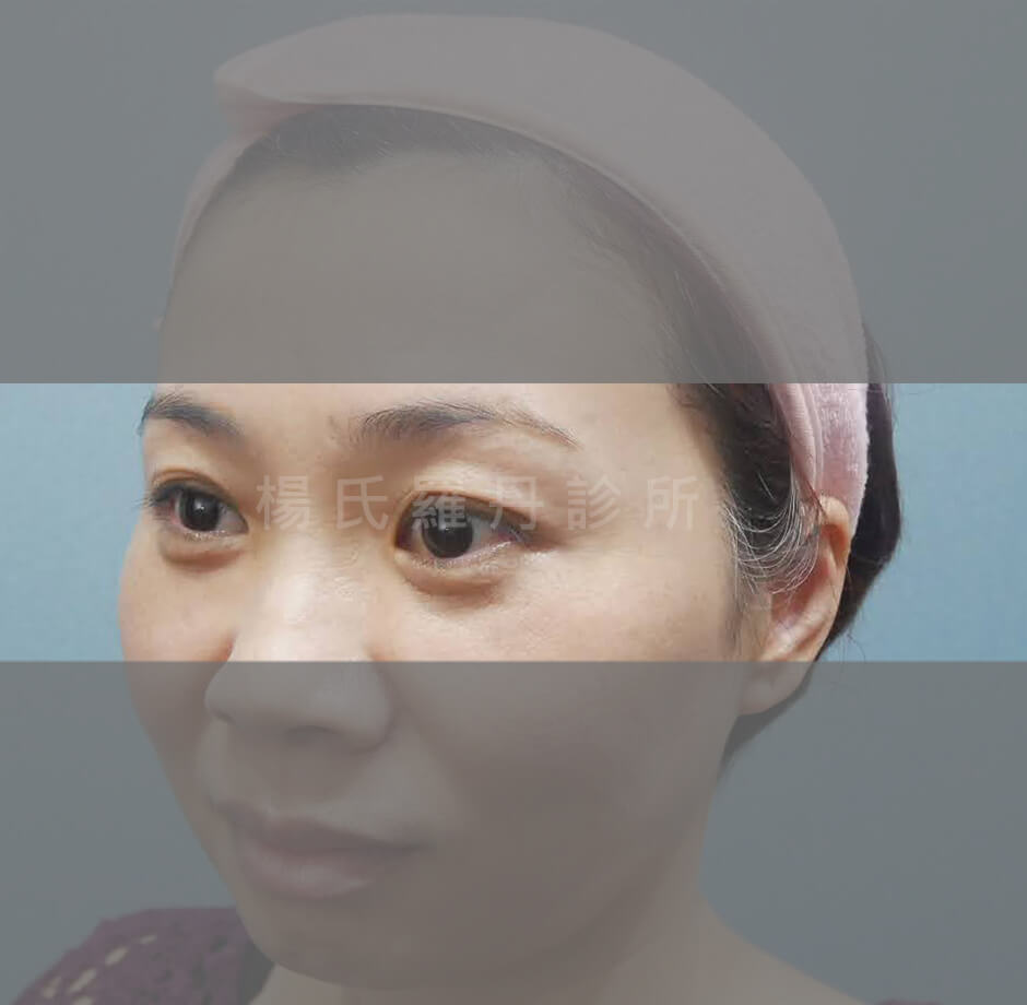 眼袋消除 眼袋 醫學美容