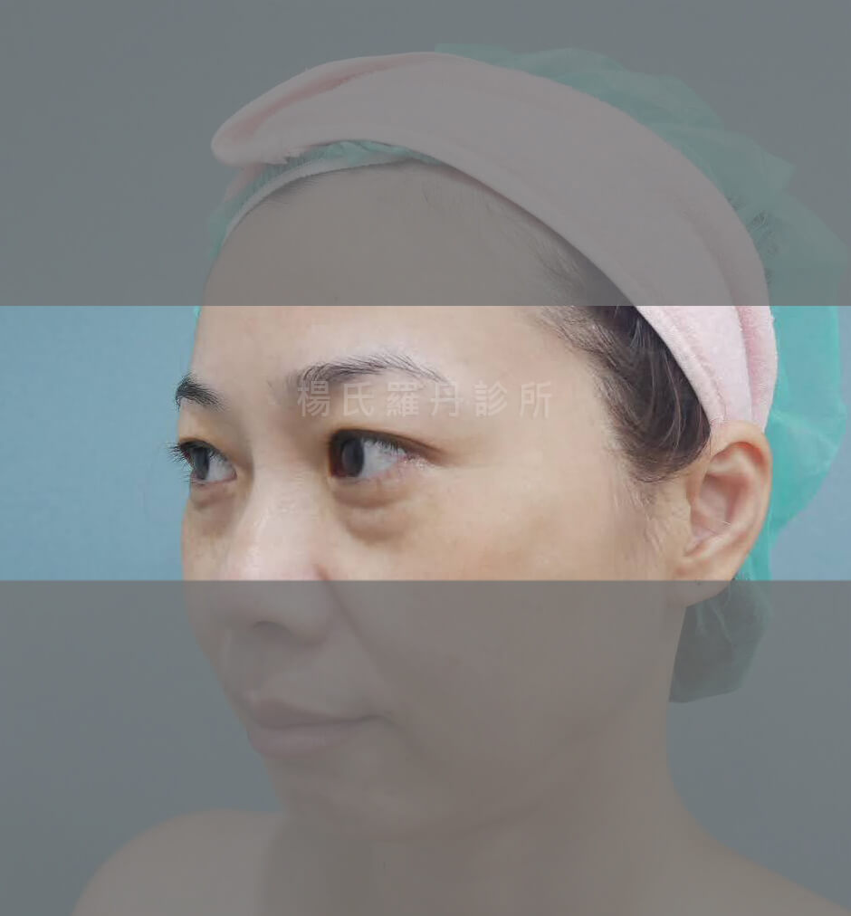 眼袋消除 眼袋 淚溝